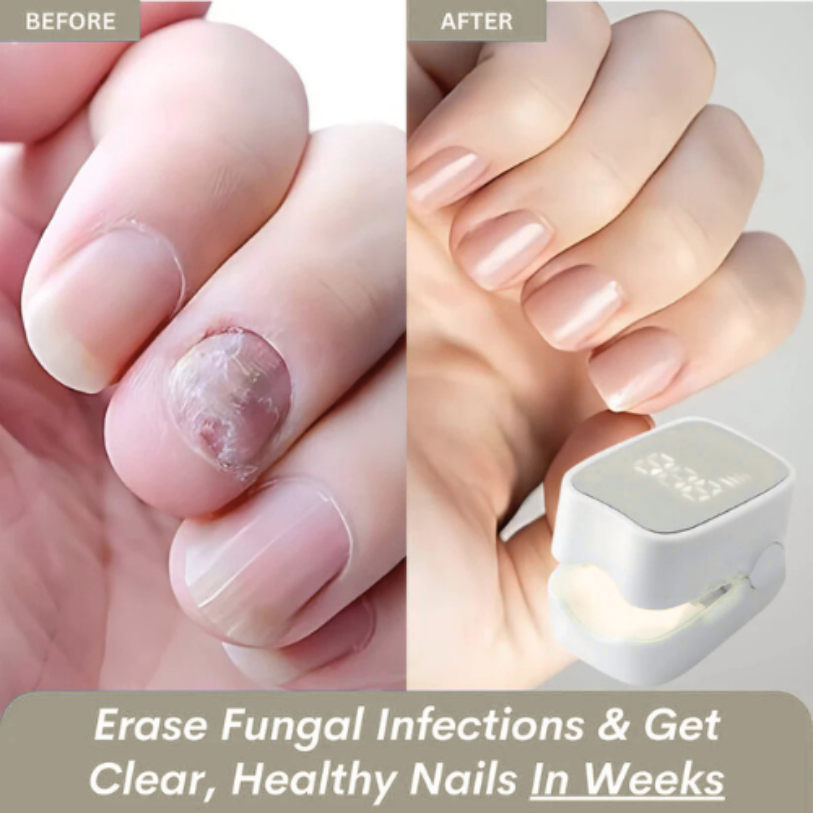 Veraela™ - Nail Fungus Laser Device