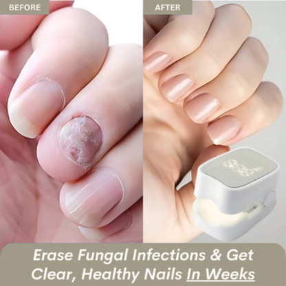 Veraela™ - Nail Fungus Laser Device