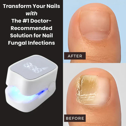 Veraela™ - Nail Fungus Laser Device